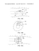 SEPARATION DEVICE FOR ULTRASOUND ELEMENT diagram and image