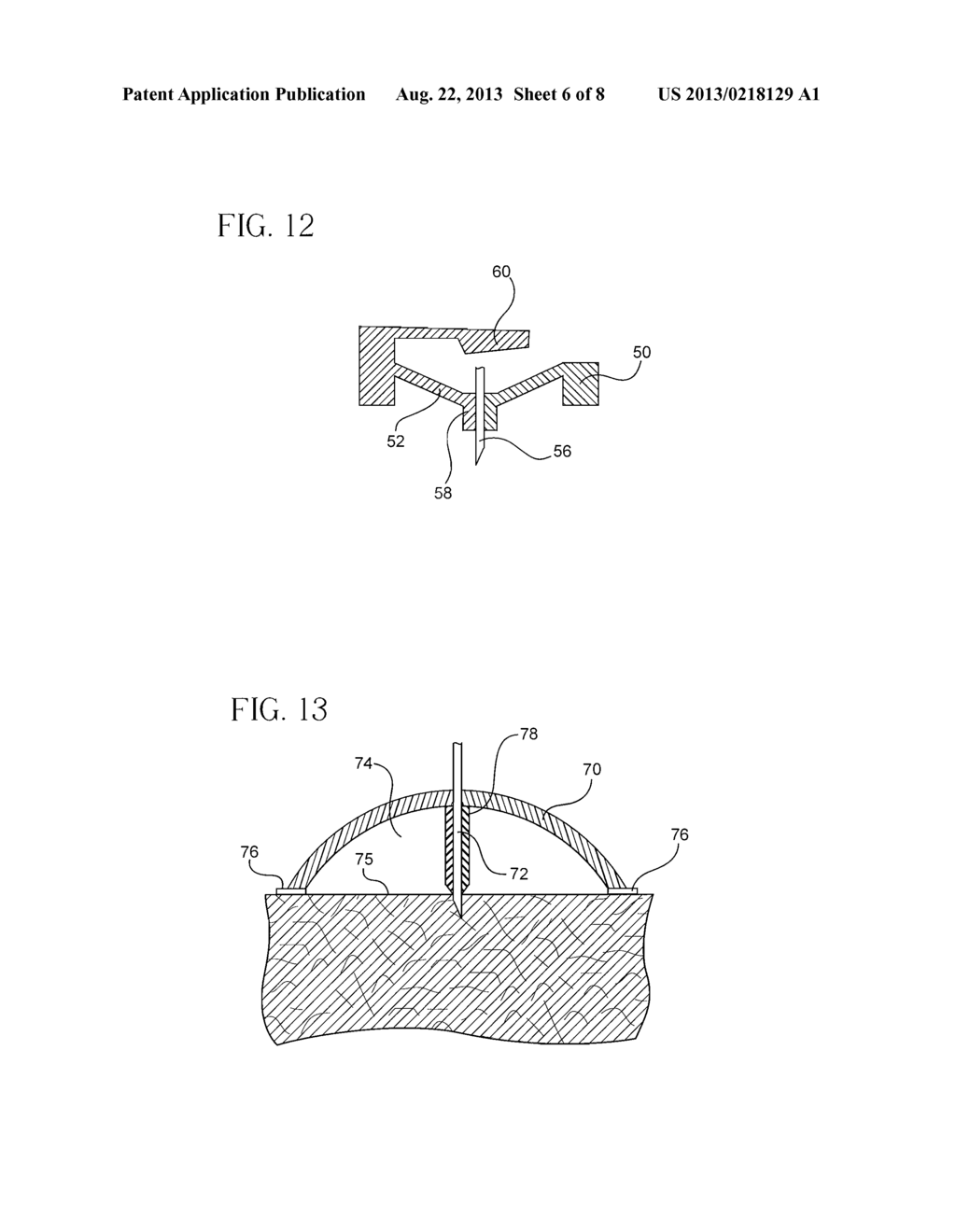 Intradermal Delivery Device - diagram, schematic, and image 07