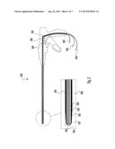 Combined Thermal Therapy and Hydrogel with Embedded Stem Cell Treatment diagram and image