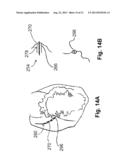 DEVICES, SYSTEMS, AND METHODS FOR EPICARDIAL NAVIGATION diagram and image