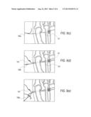 SUTURE PASSING K-WIRE diagram and image