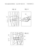 SUTURE PASSING K-WIRE diagram and image