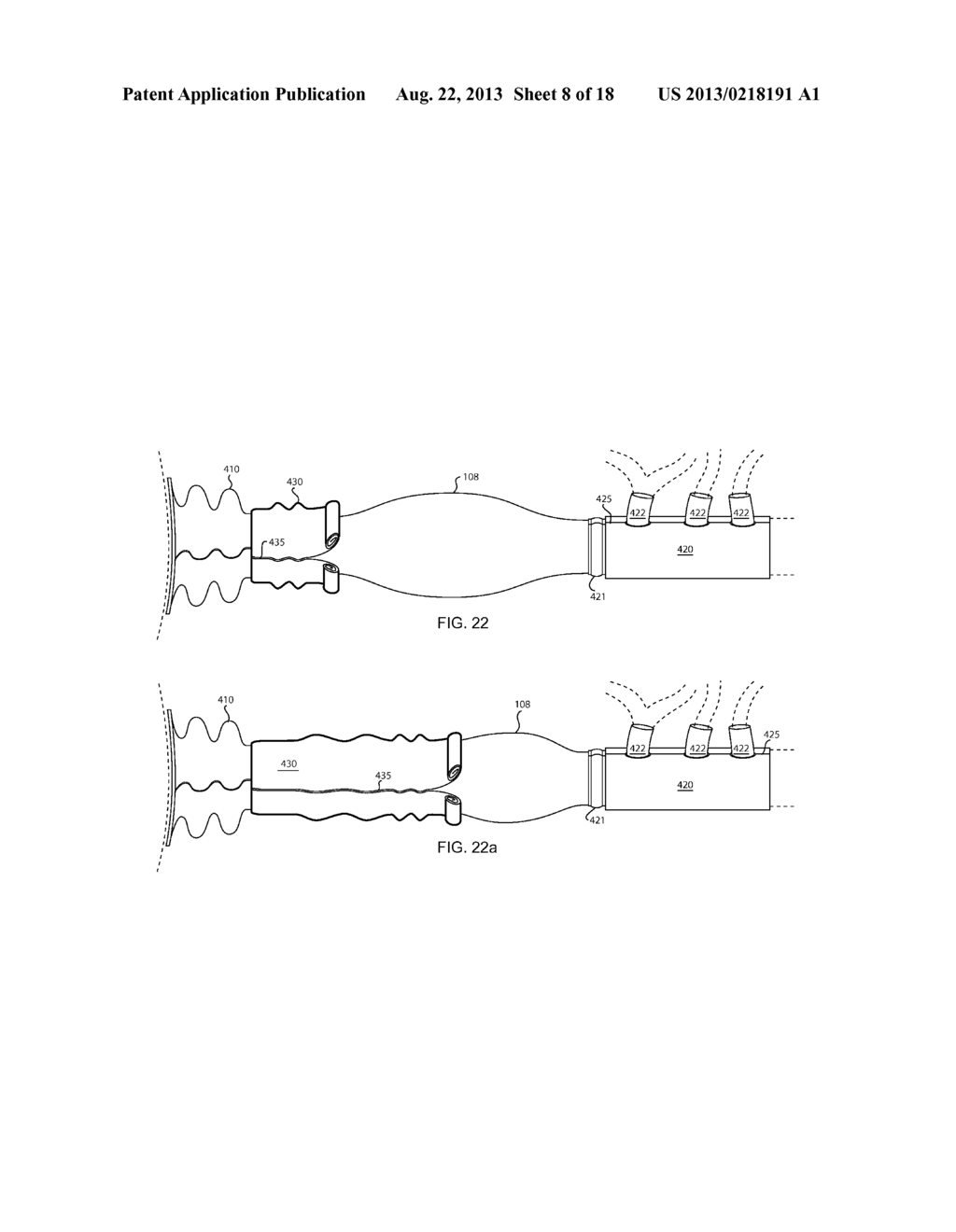 METHOD FOR DEPLOYING A SLEEVE AND TUBING DEVICE FOR RESTRICTING AND     CONSTRICTING ANEURYSMS AND A SLEEVE AND TUBING DEVICE AND SYSTEM - diagram, schematic, and image 09