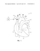 METHODS FOR USING A PULMONARY ARTERY ELECTRODE diagram and image