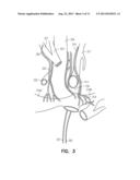 METHODS FOR USING A PULMONARY ARTERY ELECTRODE diagram and image