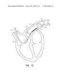 METHODS FOR USING A PULMONARY ARTERY ELECTRODE diagram and image