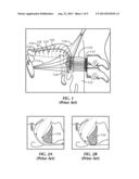 Method of Stimulating a Hypoglossal Nerve for Controlling the Position of     a Patient s Tongue diagram and image