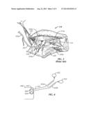 Method of Stimulating a Hypoglossal Nerve for Controlling the Position of     a Patient s Tongue diagram and image