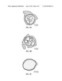 Method of Stimulating a Hypoglossal Nerve for Controlling the Position of     a Patient s Tongue diagram and image