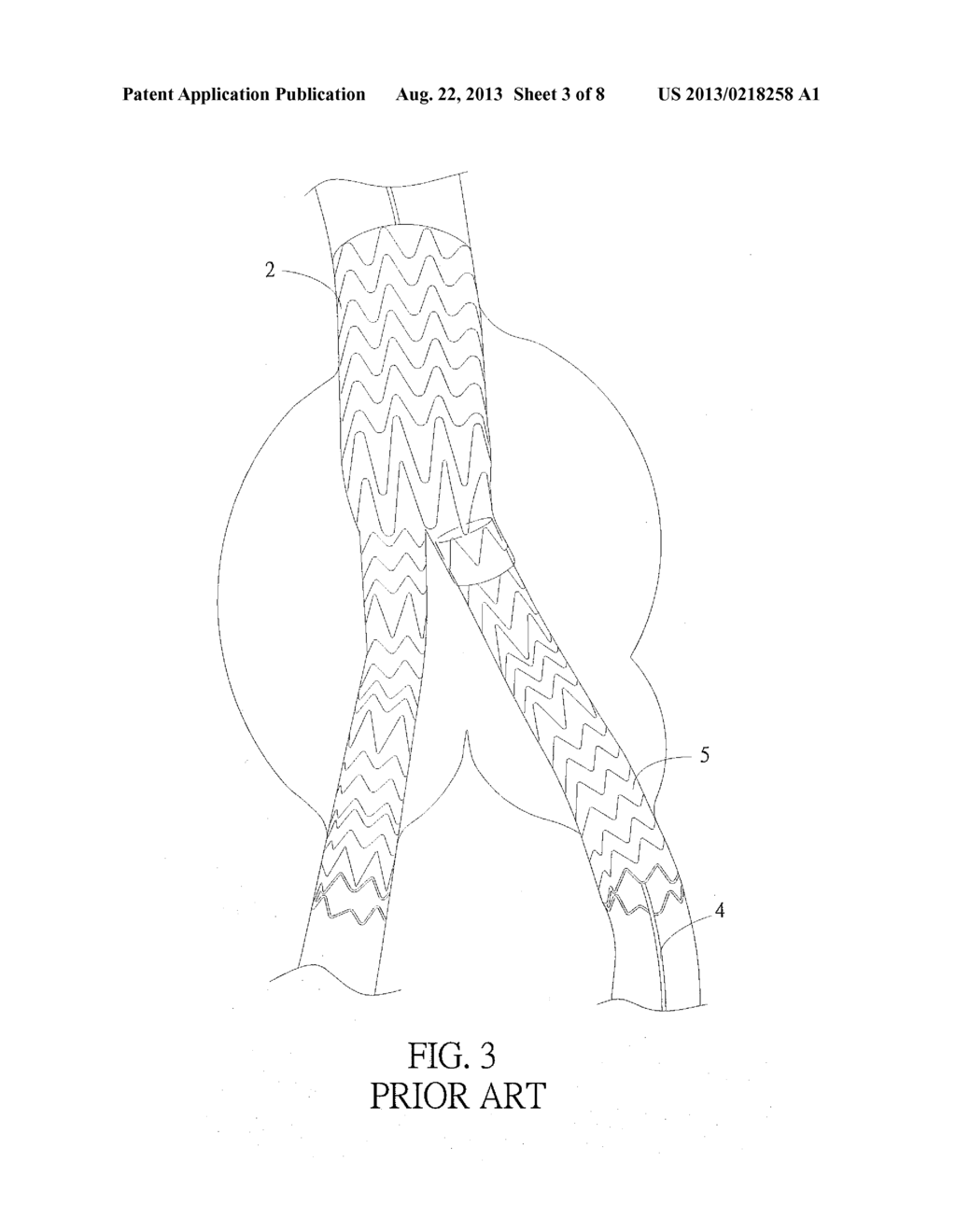 Abdominal Aortic Stent - diagram, schematic, and image 04