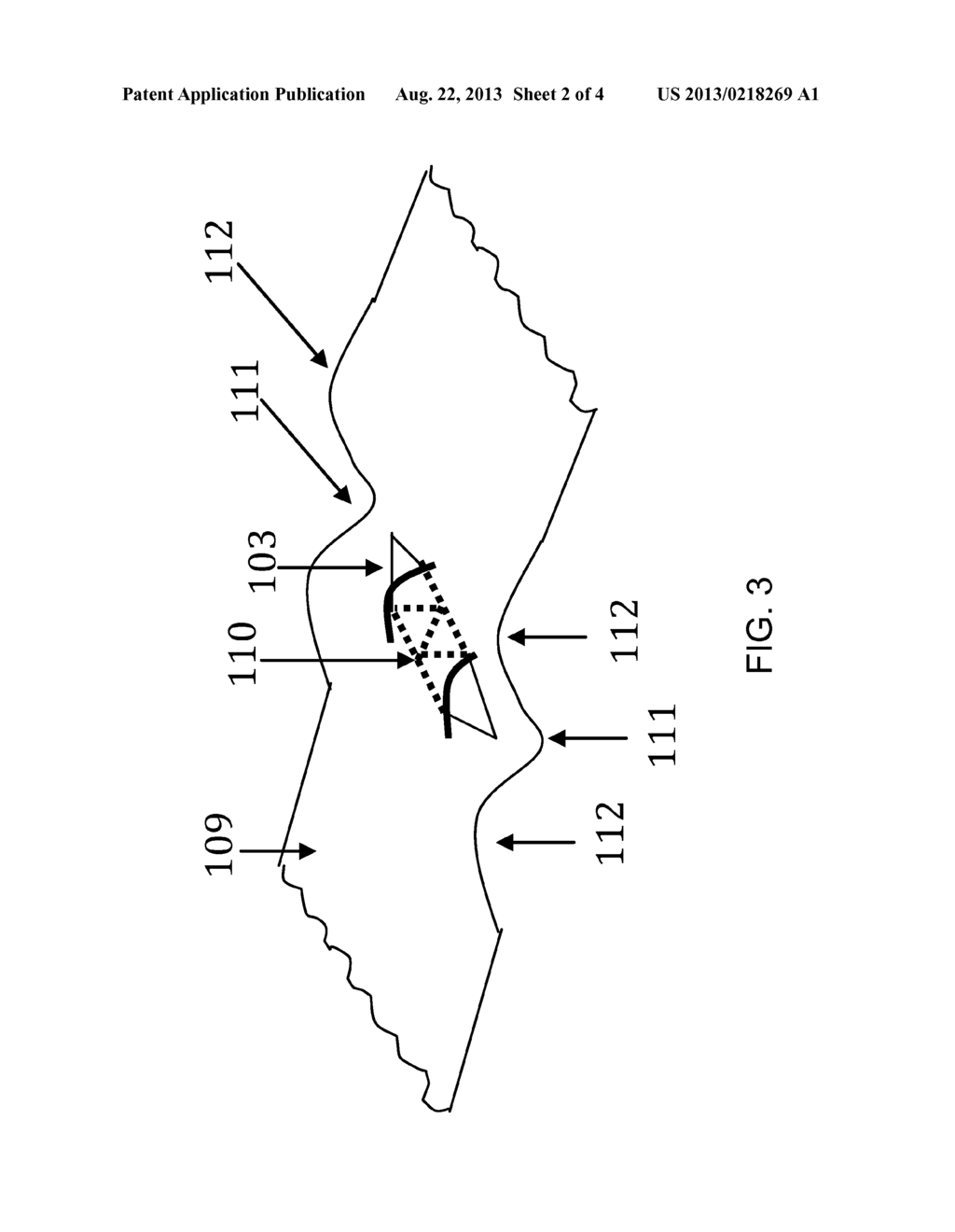 DEVICE AND METHOD FOR TREATMENT OF RETINAL DETACHMENT AND OTHER MALADIES     OF THE EYE - diagram, schematic, and image 03