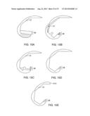 SYSTEMS AND METHODS FOR PROVIDING AN ASYMMETRICAL TIBIAL COMPONENT diagram and image