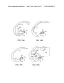 SYSTEMS AND METHODS FOR PROVIDING AN ASYMMETRICAL TIBIAL COMPONENT diagram and image