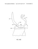 SYSTEMS AND METHODS FOR PROVIDING AN ASYMMETRICAL TIBIAL COMPONENT diagram and image