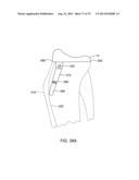 SYSTEMS AND METHODS FOR PROVIDING AN ASYMMETRICAL TIBIAL COMPONENT diagram and image