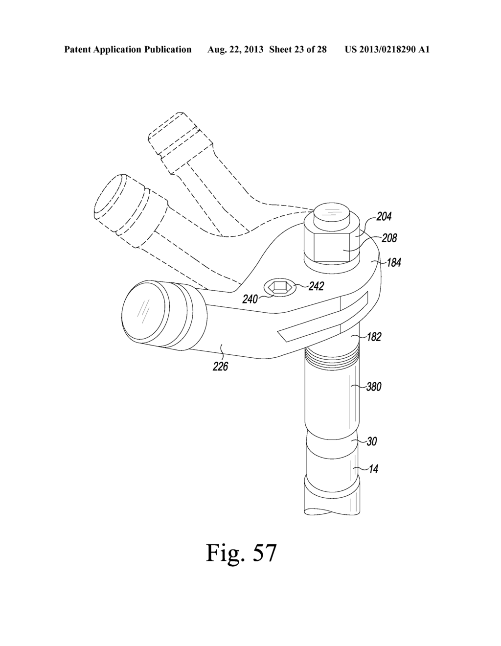 REVISION HIP PROSTHESIS HAVING AN IMPLANTABLE DISTAL STEM COMPONENT - diagram, schematic, and image 24