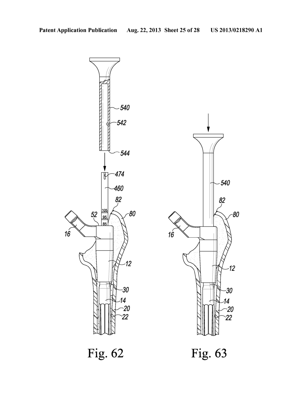 REVISION HIP PROSTHESIS HAVING AN IMPLANTABLE DISTAL STEM COMPONENT - diagram, schematic, and image 26