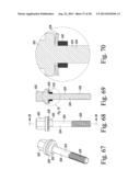 REVISION HIP PROSTHESIS HAVING AN IMPLANTABLE DISTAL STEM COMPONENT diagram and image