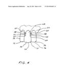 Dental Appliance diagram and image