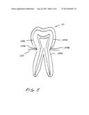 Dental Appliance diagram and image