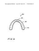 Dental Appliance diagram and image