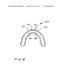 Dental Appliance diagram and image