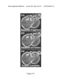 ASSESSMENT OF CELLULAR FRAGMENTATION DYNAMICS FOR DETECTION OF HUMAN     EMBRYONIC ANEUPLOIDY diagram and image