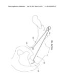 SYSTEMS, DEVICES AND METHODS FOR TREATING PELVIC FLOOR DISORDERS diagram and image