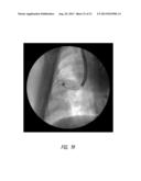 LUNG BIOPSY NEEDLE diagram and image