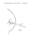 DEVICES AND METHODS FOR PERFORMING PROCEDURES ON A BREAST diagram and image