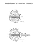 DEVICES AND METHODS FOR PERFORMING PROCEDURES ON A BREAST diagram and image