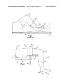 FEMORAL GUIDE FOR KNEE SURGERY diagram and image