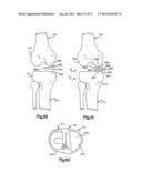 FEMORAL GUIDE FOR KNEE SURGERY diagram and image