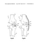 FEMORAL GUIDE FOR KNEE SURGERY diagram and image