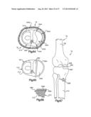 FEMORAL GUIDE FOR KNEE SURGERY diagram and image