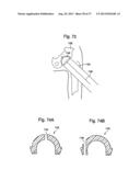 FEMORAL GUIDE FOR KNEE SURGERY diagram and image