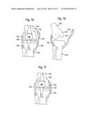 FEMORAL GUIDE FOR KNEE SURGERY diagram and image