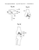 FEMORAL GUIDE FOR KNEE SURGERY diagram and image