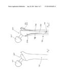 FEMORAL IMPLANT REVISION TOOL diagram and image