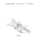 METHOD AND SYSTEM FOR LIGATING A BODY PART diagram and image