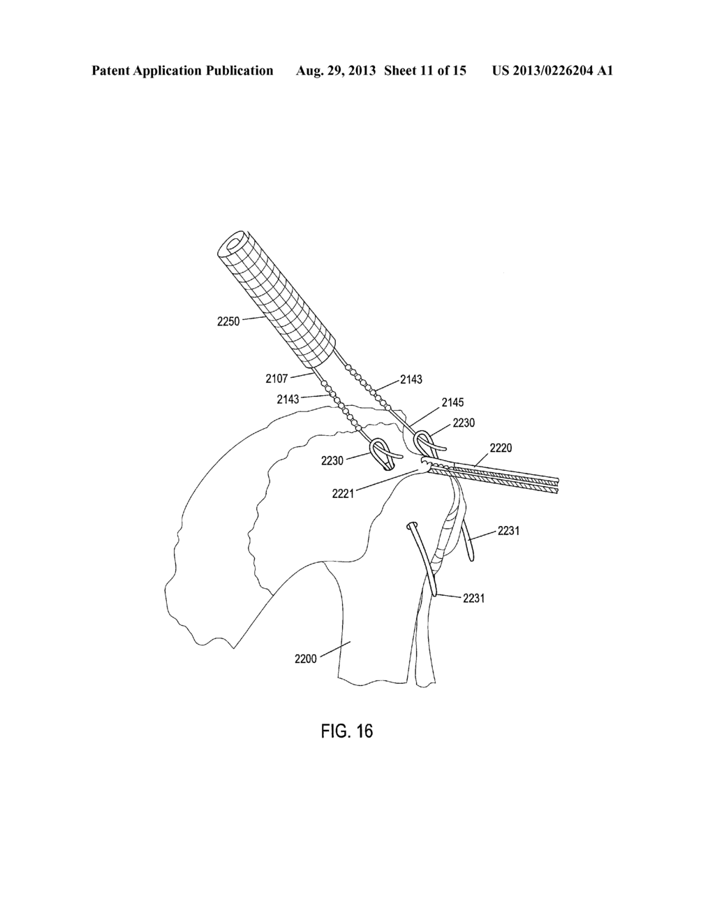 SUTURE MESH AND METHOD OF USE - diagram, schematic, and image 12