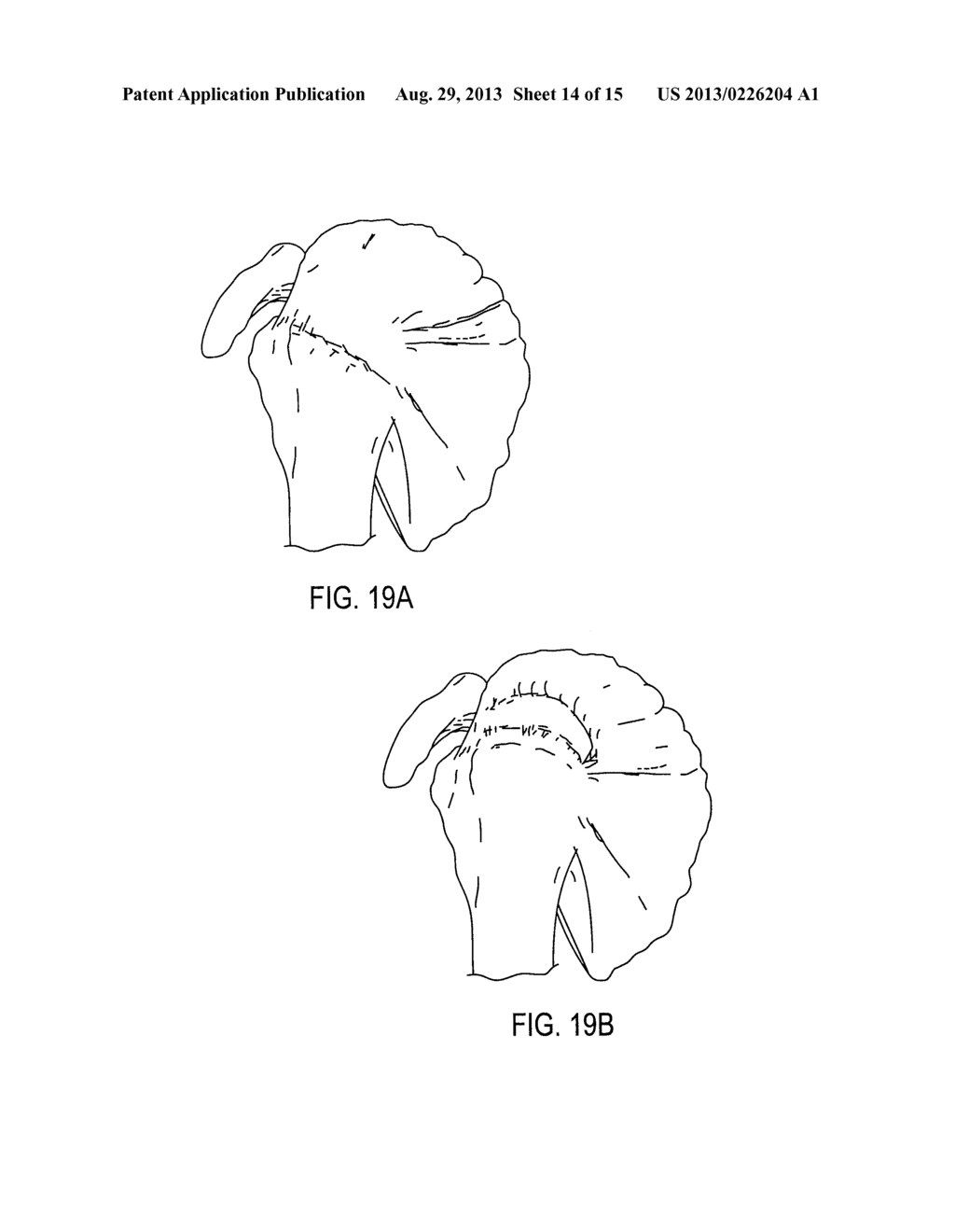 SUTURE MESH AND METHOD OF USE - diagram, schematic, and image 15