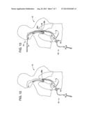 Pediatric Esophageal Atresia Magnetic Anastomosis System diagram and image