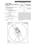 Locking Plate with Screw Fixation from Opposite Cortex diagram and image