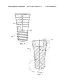 Locking Plate with Screw Fixation from Opposite Cortex diagram and image