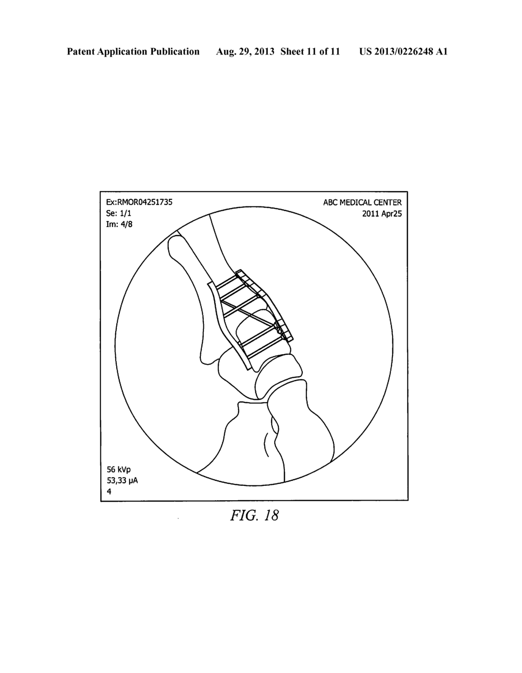 Locking Plate with Screw Fixation from Opposite Cortex - diagram, schematic, and image 12