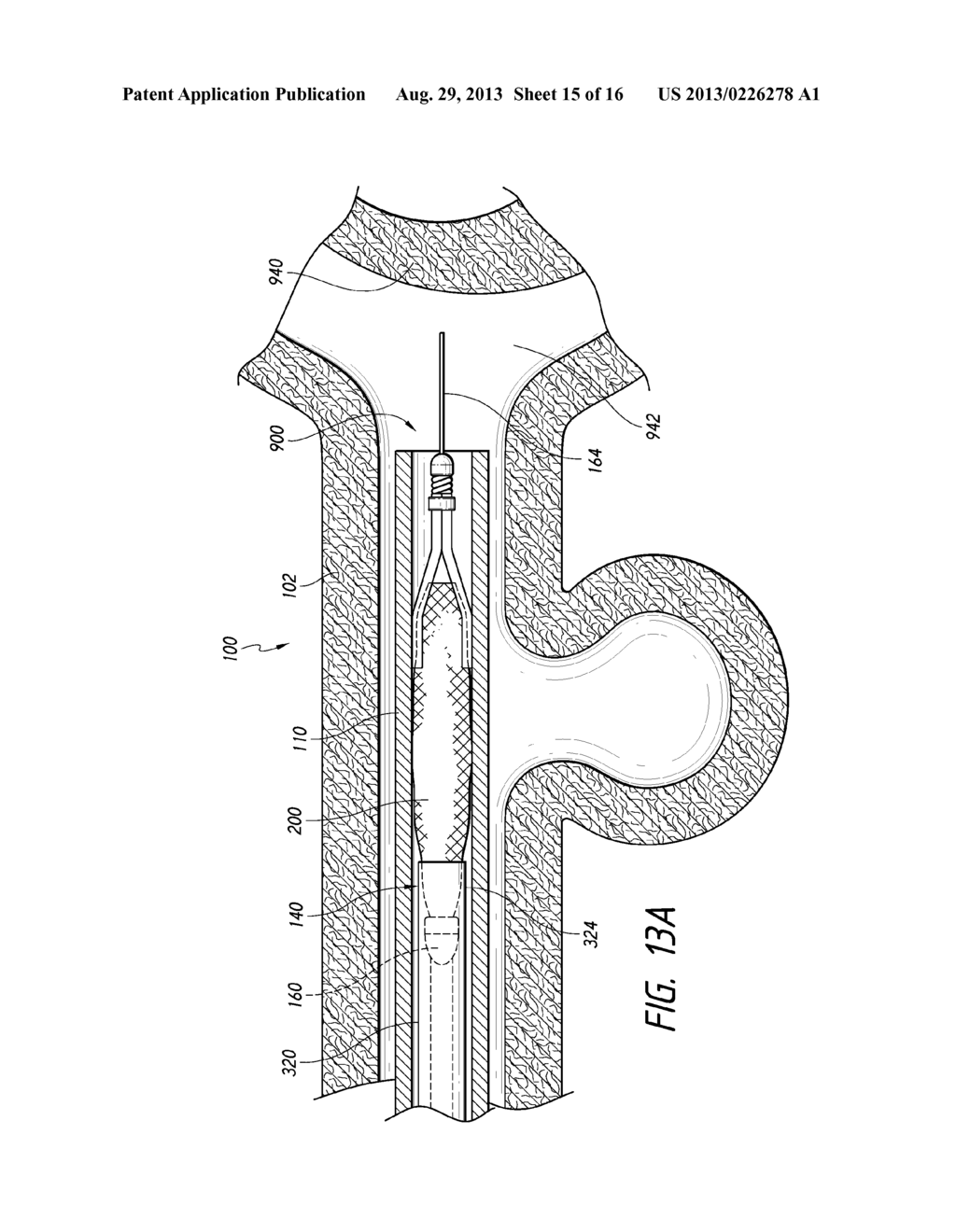 METHODS AND APPARATUS FOR LUMINAL STENTING - diagram, schematic, and image 16