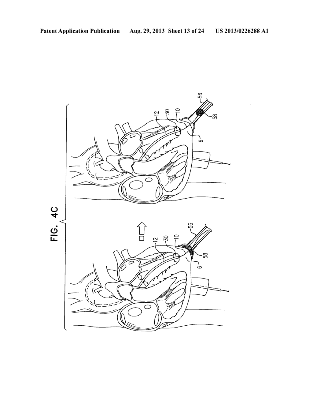 MINIMALLY INVASIVE SURGICAL TECHNIQUES - diagram, schematic, and image 14