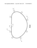 PERCUTANEOUS ANNULOPLASTY SYSTEM WITH ANTERIOR-POSTERIOR ADJUSTMENT diagram and image