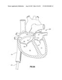 PERCUTANEOUS ANNULOPLASTY SYSTEM WITH ANTERIOR-POSTERIOR ADJUSTMENT diagram and image